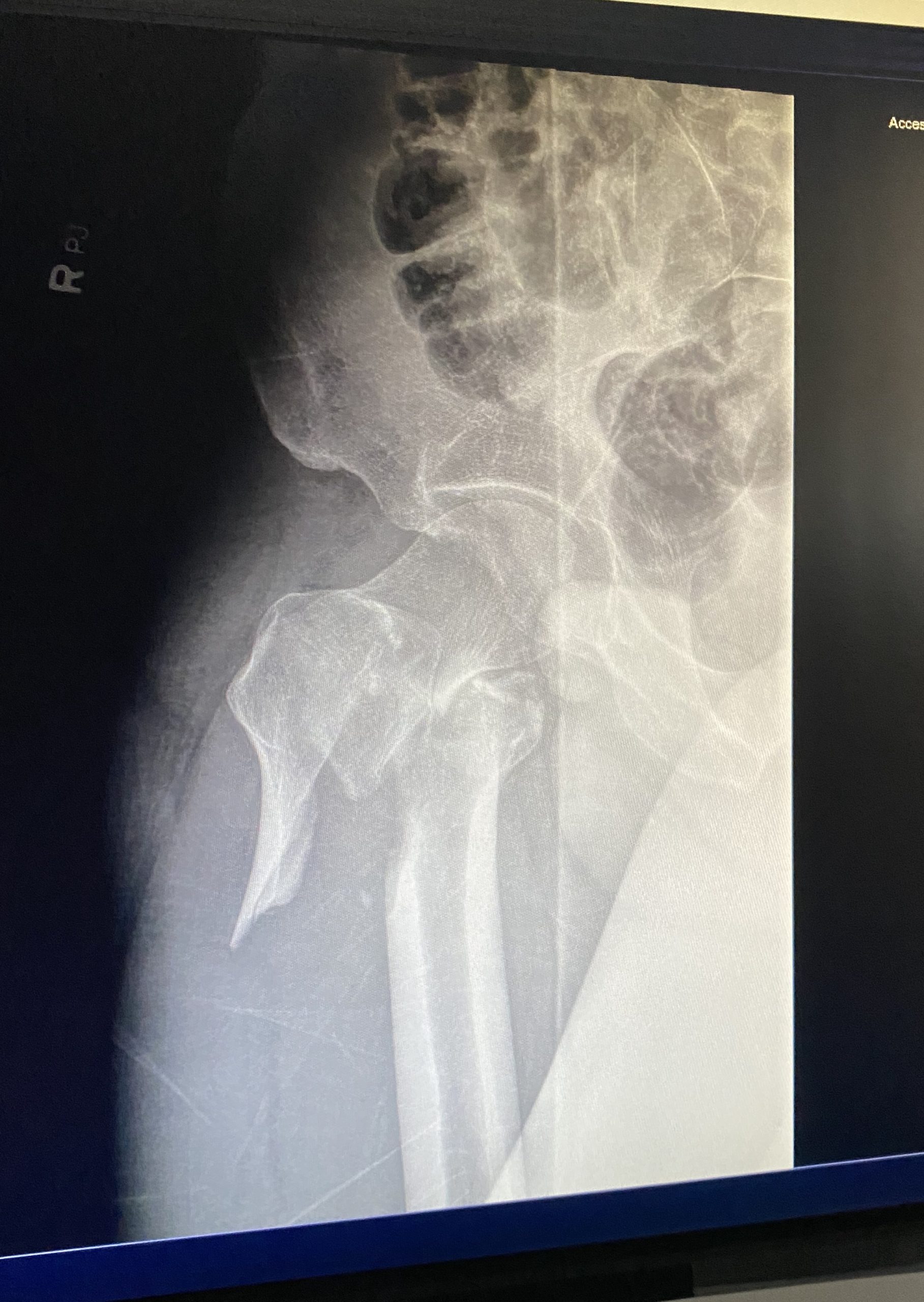 Yes, that's my femur